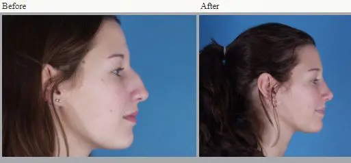 Rhinoplasty vs. Non-Invasive Rhinoplasty: What’s the Difference?