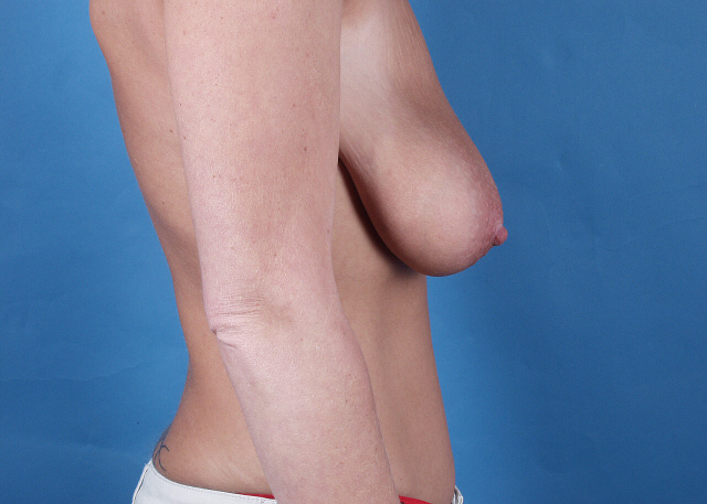 Post Bariatric Surgery Before and After Pictures