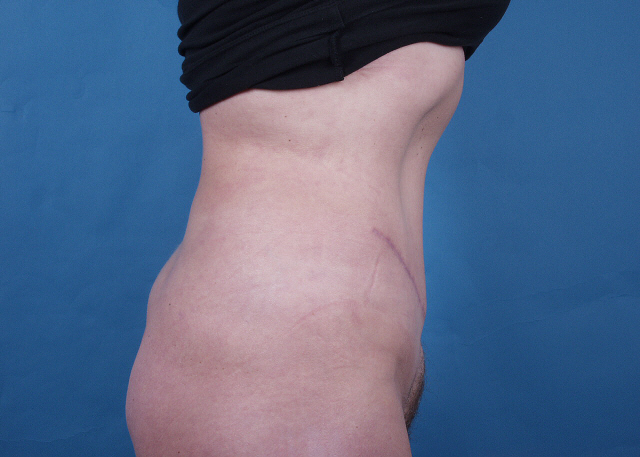tummy tuck before and after photos