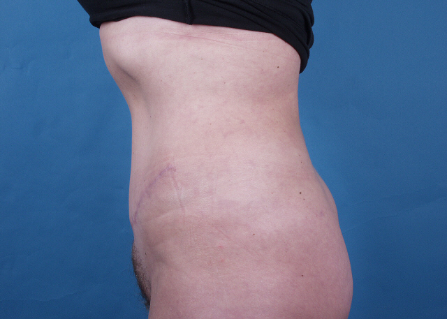 tummy tuck before and after photos