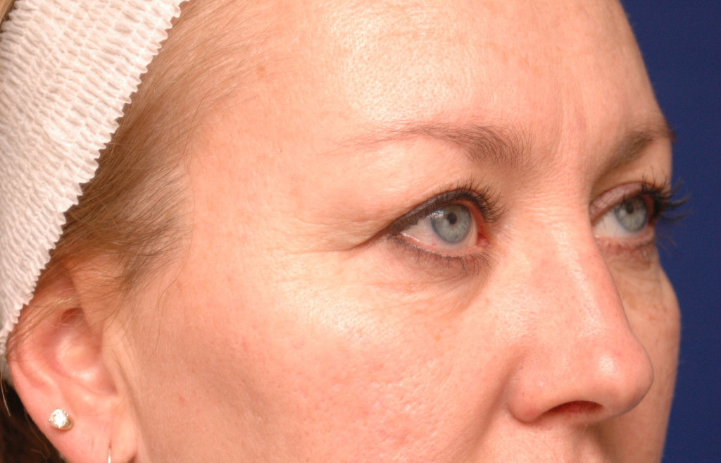 blepharoplasty before and after pictures