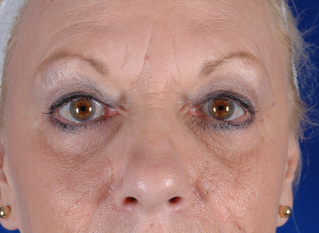 eyelid surgery before and after pictures