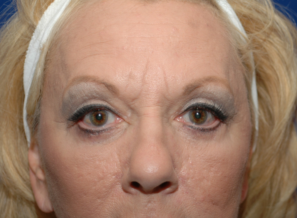 eyelid surgery before and after pictures