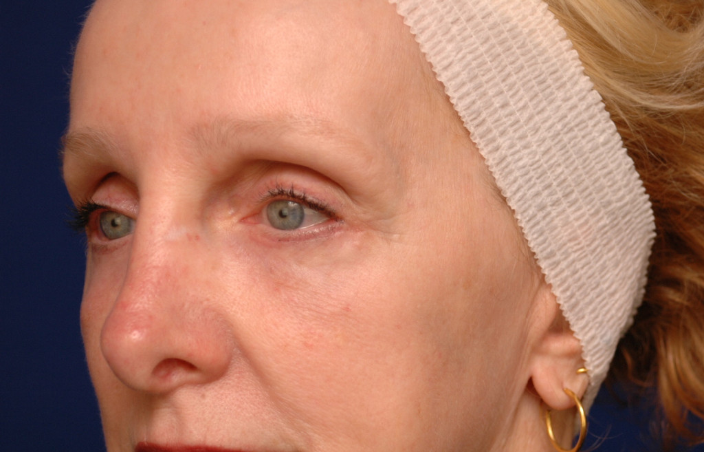 eyelid surgery before and after photos