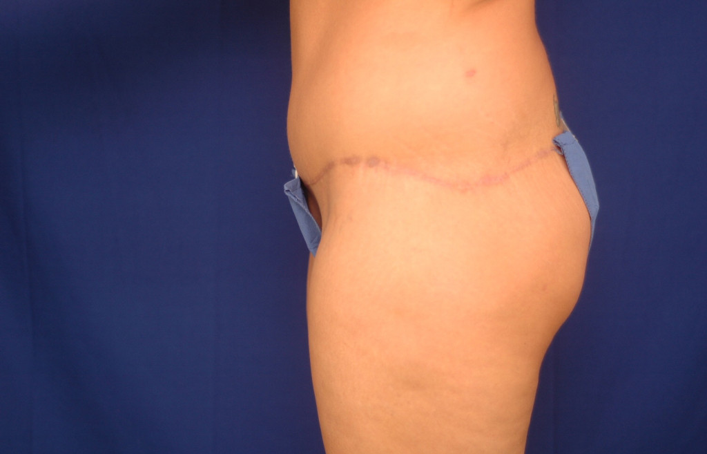 lower Body Lift before and after photos