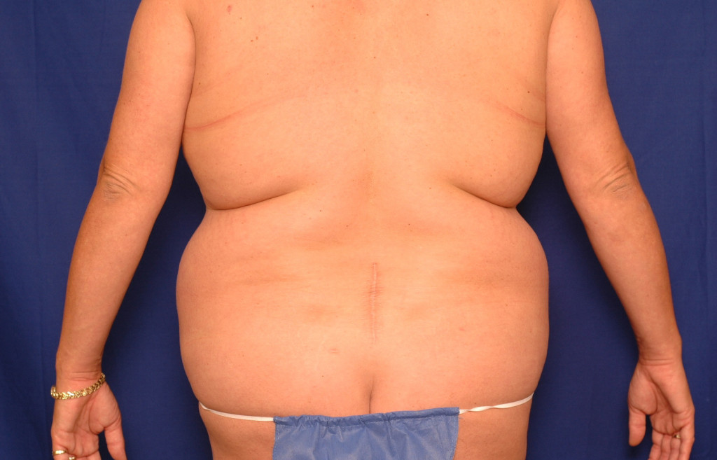 Body Lift before and after photos