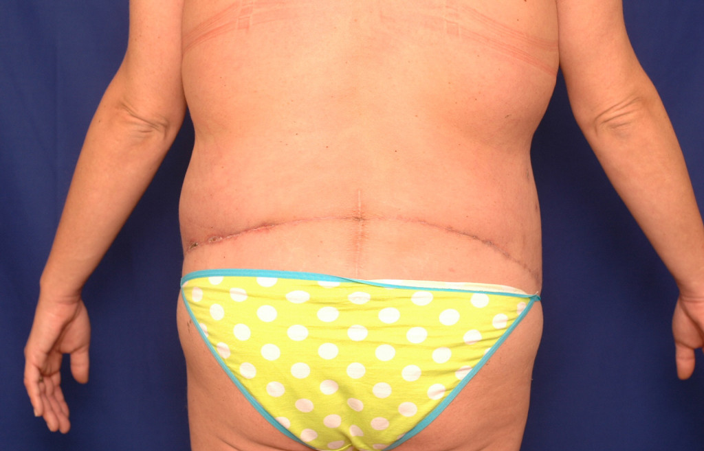 Body Lift before and after pictures