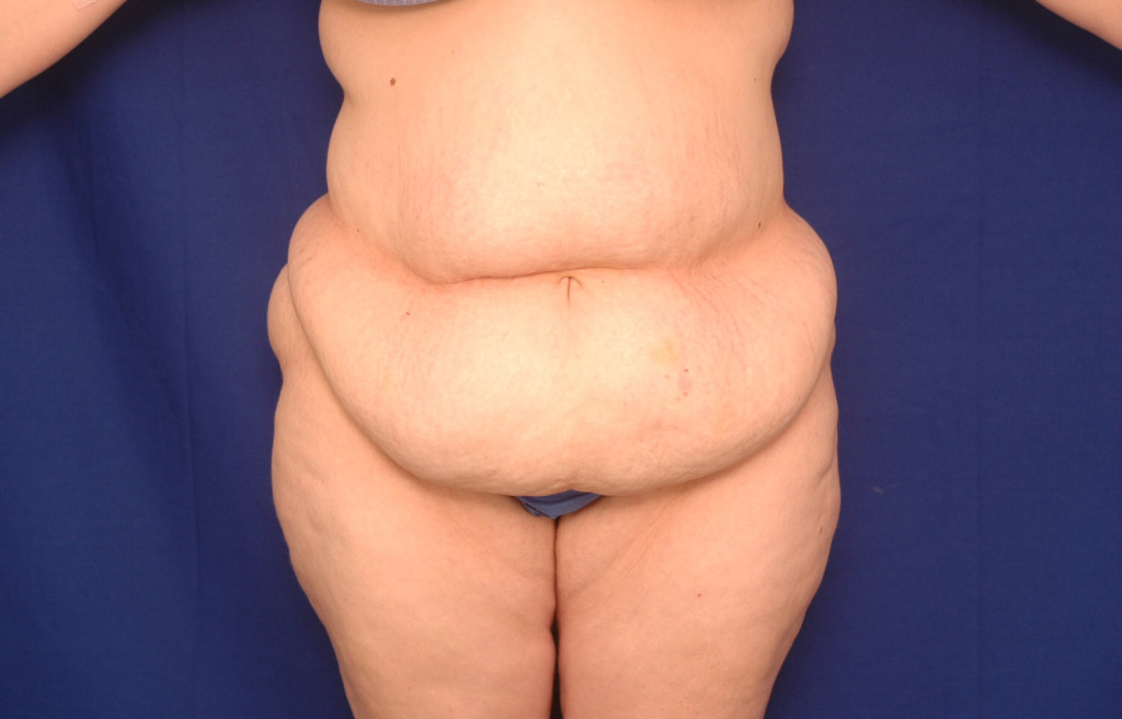 Body Lift before and after pictures