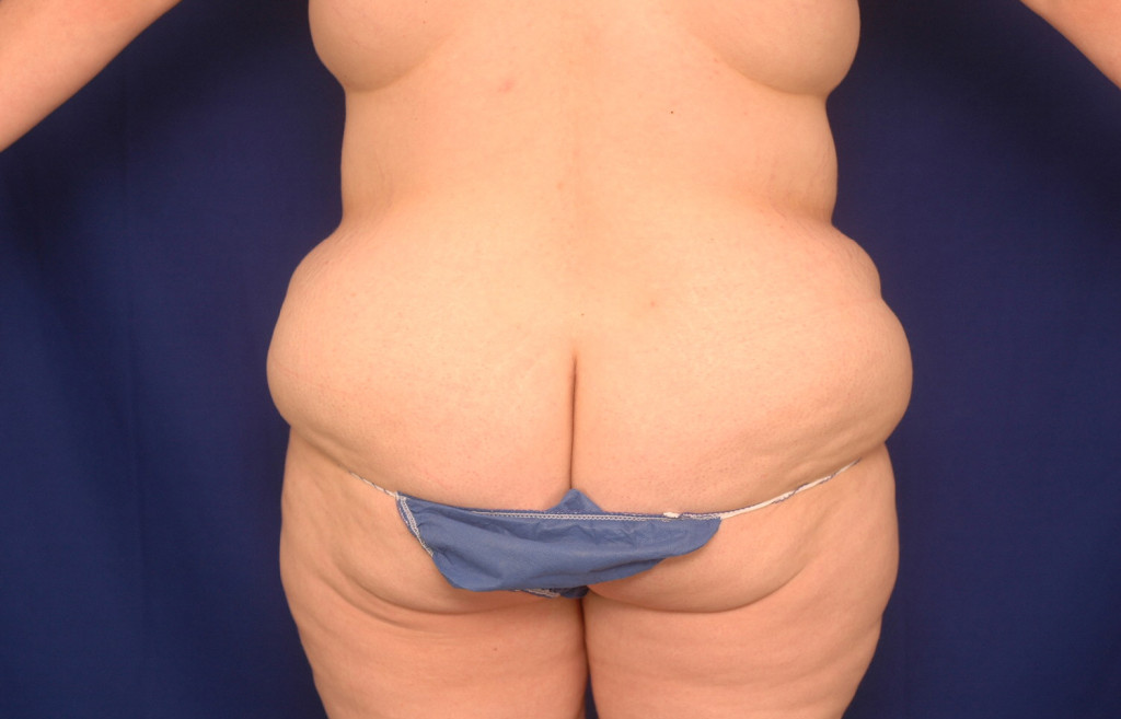 Body Lift before and after pictures
