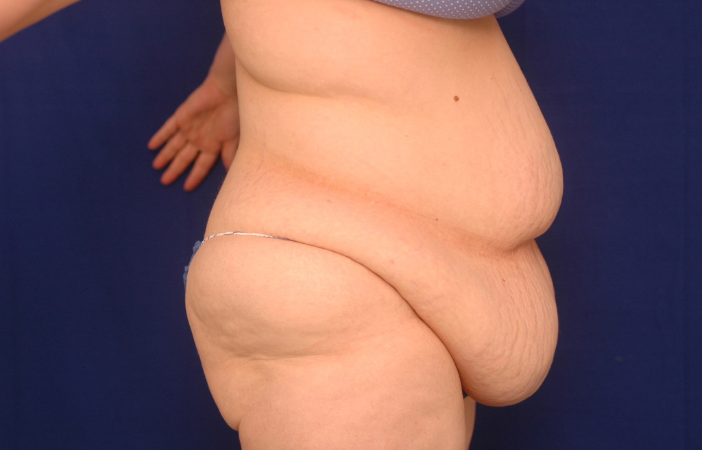 Body Lift before and after pictures