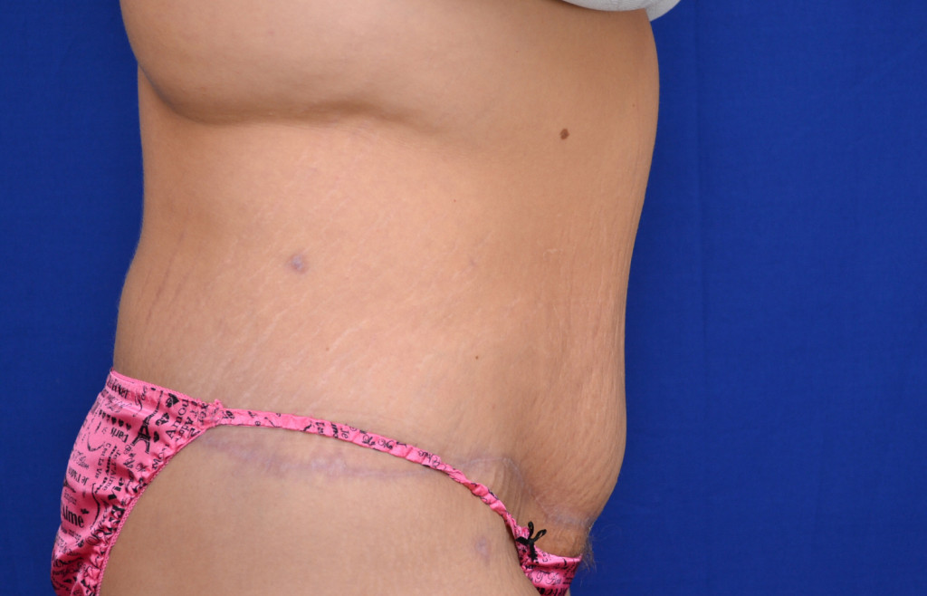 Body Lift before and after photos
