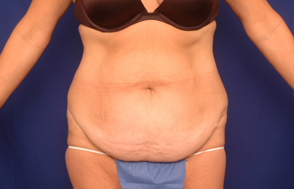 Body Lift before and after photos