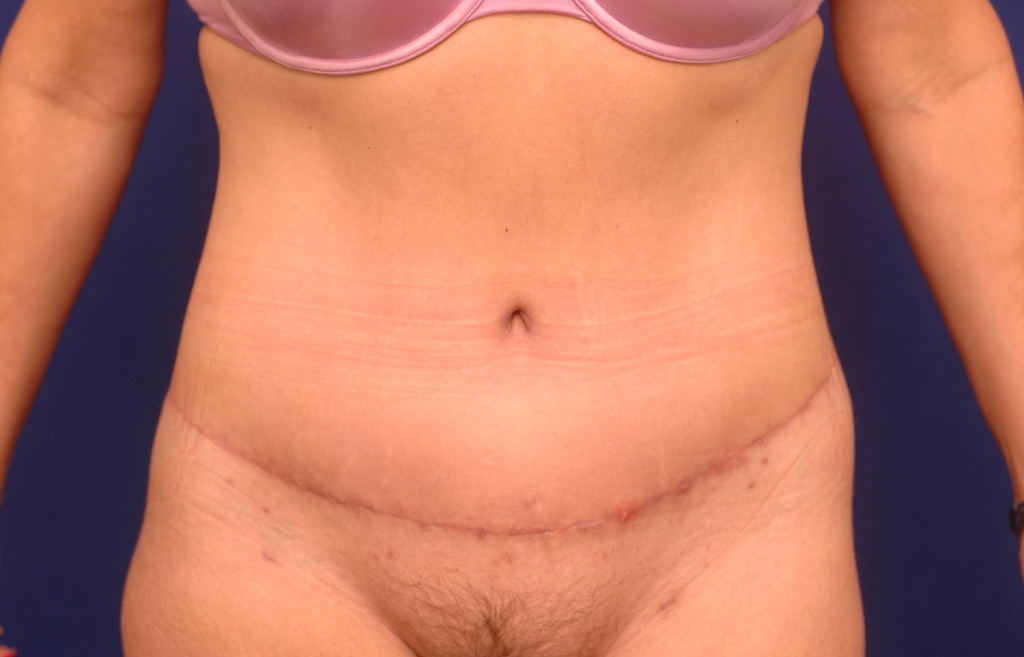 Body Lift before and after photos