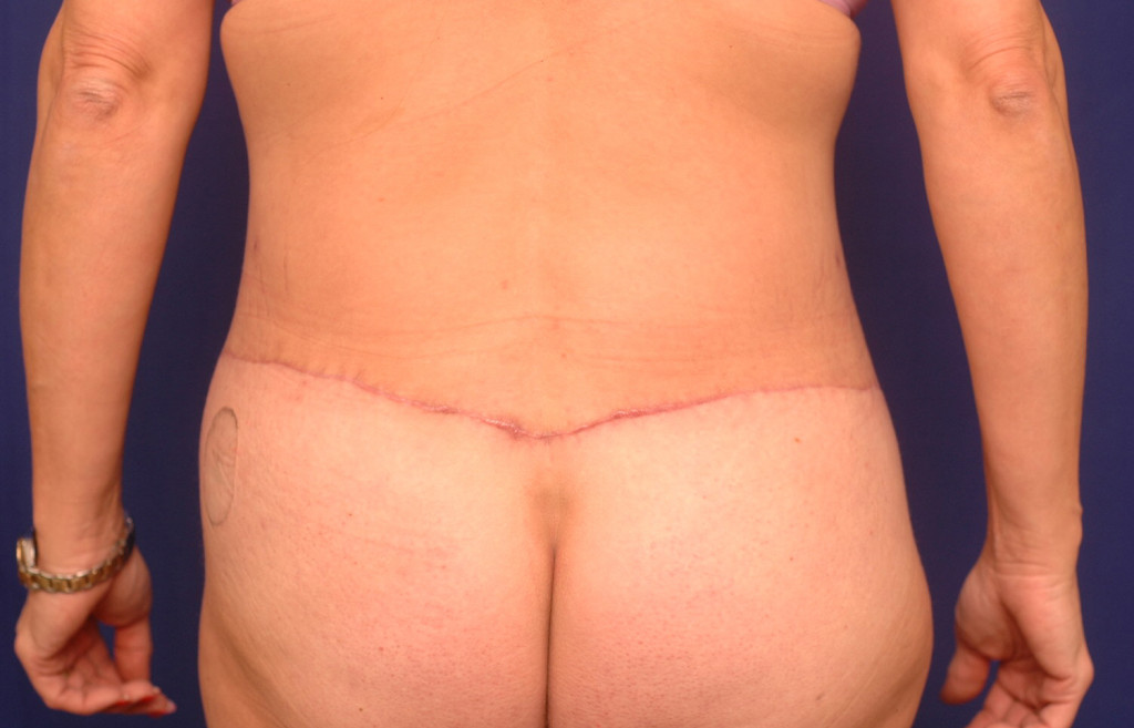 Body Lift before and after photos