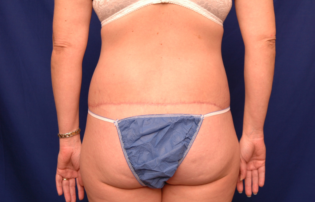 lower Body Lift before and after photos