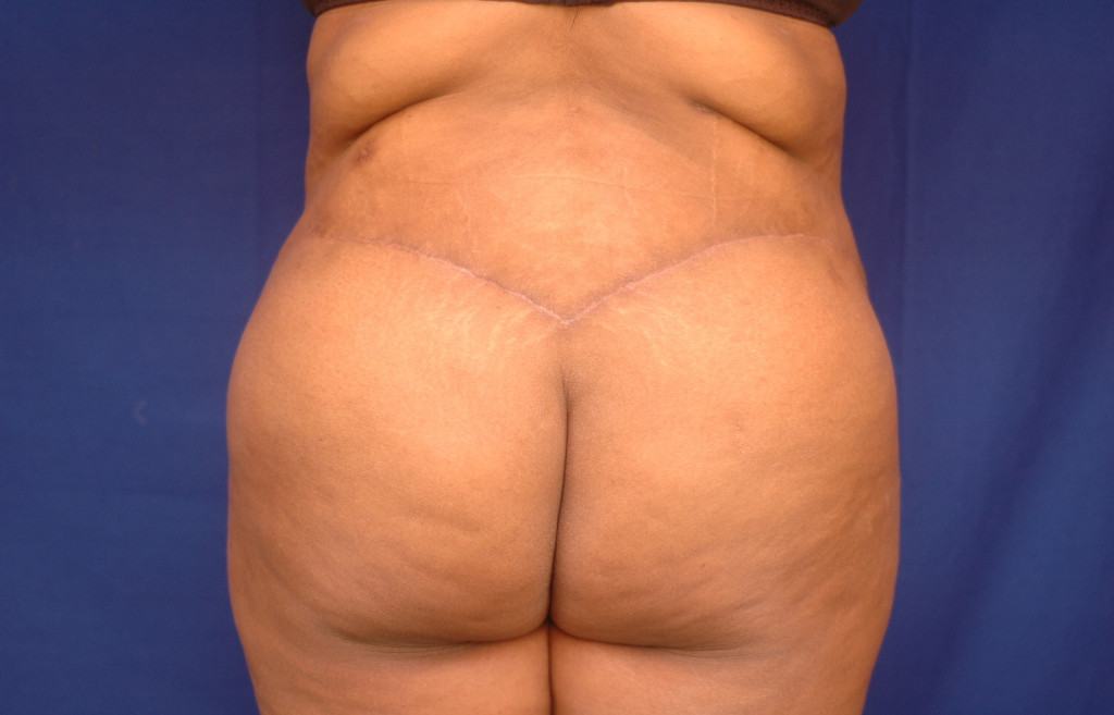 Body Lift before and after photos