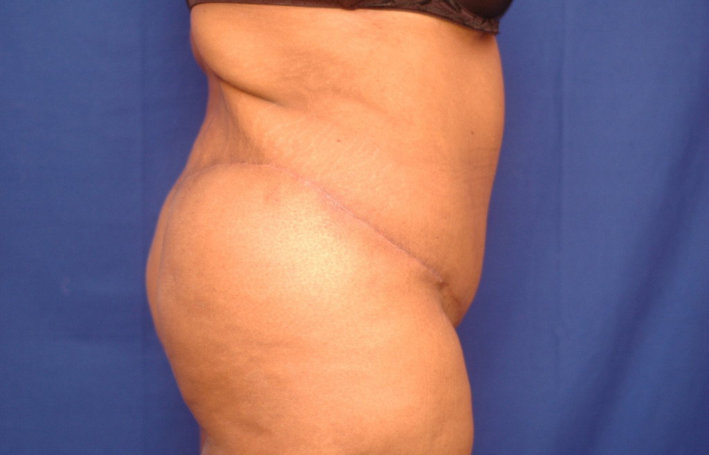 Body Lift before and after photos