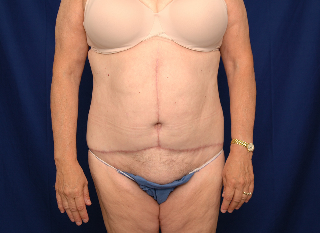 Body Lift before and after photos