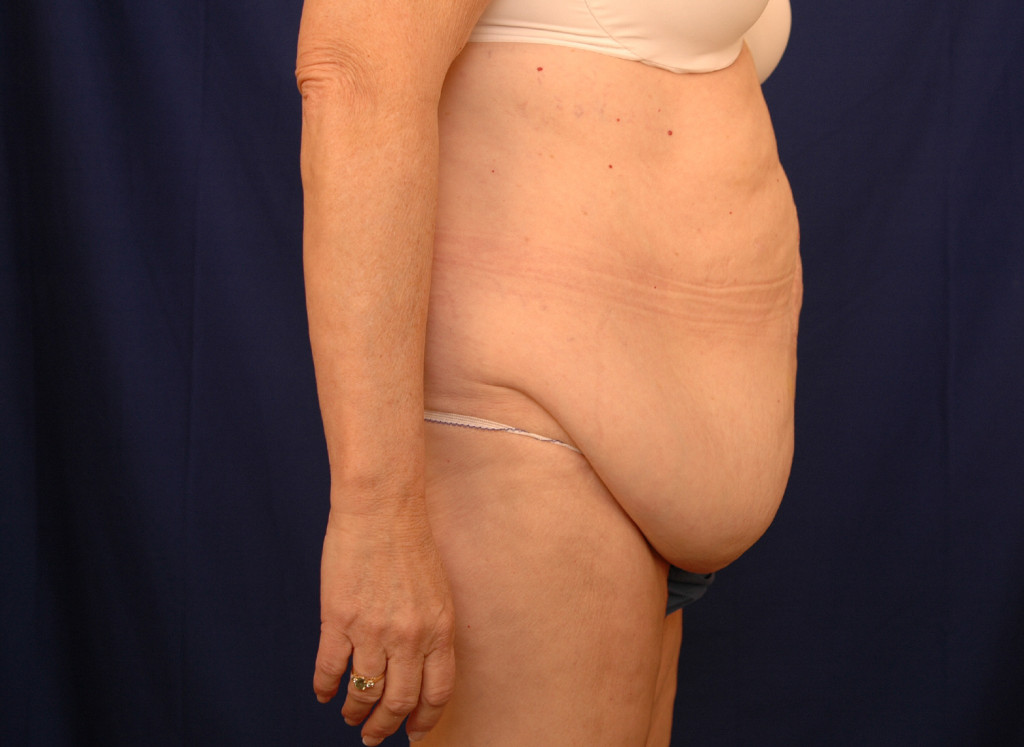 Body Lift before and after photos