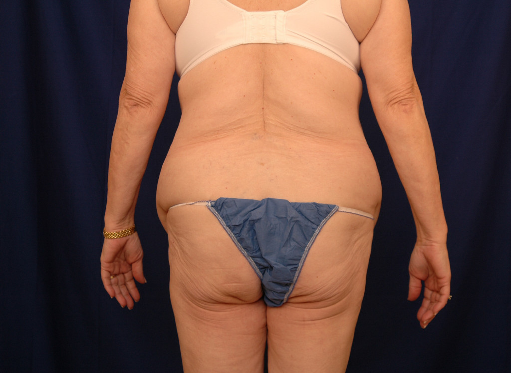 Body Lift before and after photos