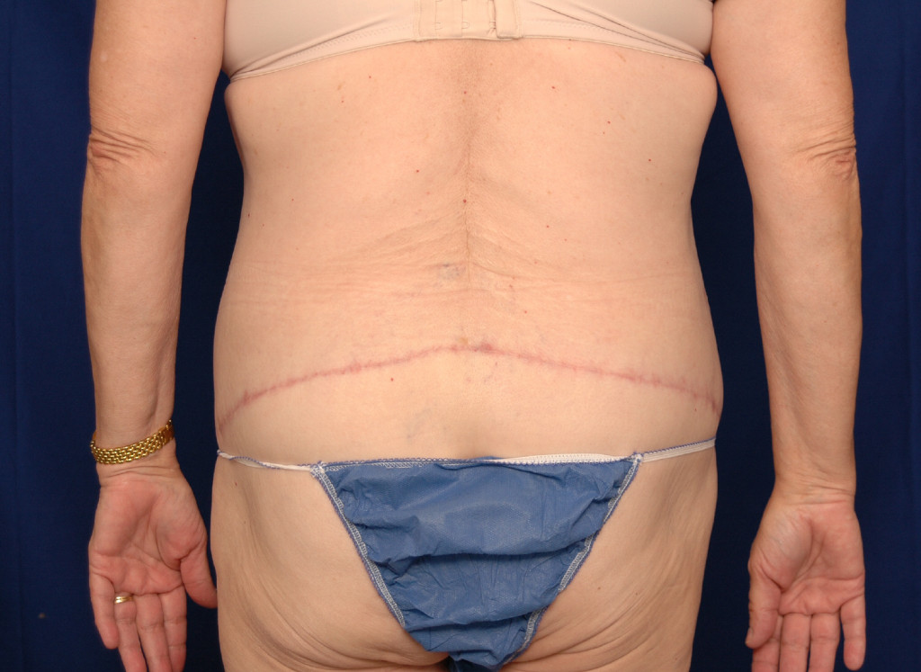 Body Lift before and after photos