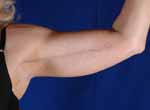 Arm Lift Before and After pictures