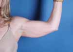 Arm Lift Before and After pictures