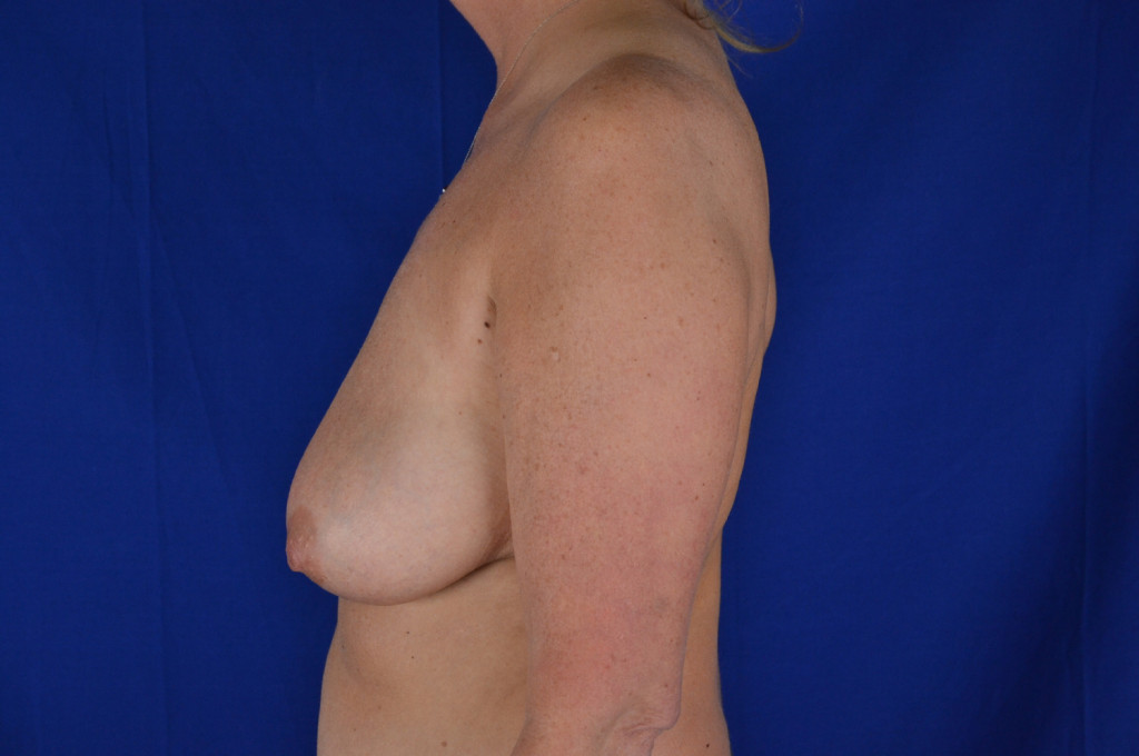 breast lift before and after photos