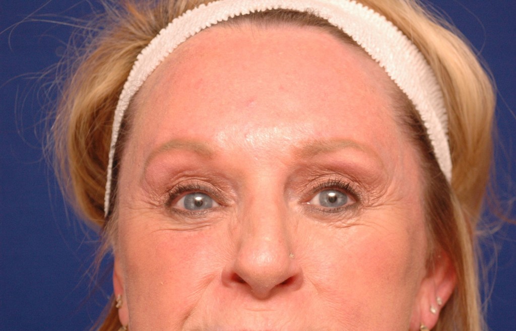 brow lift before and after photos