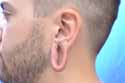 earlobe surgery Before and After Pictures