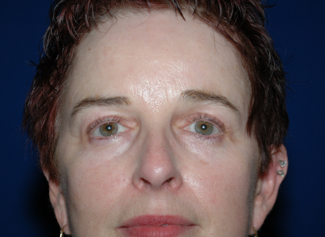 brow lift before and after photos
