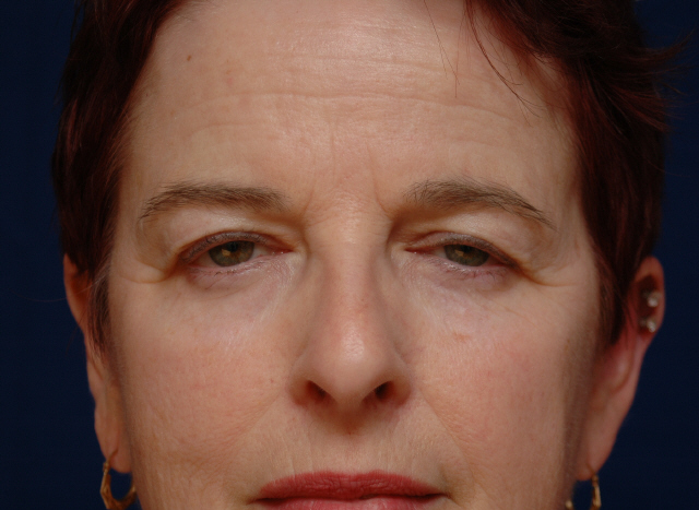 brow lift before and after photos