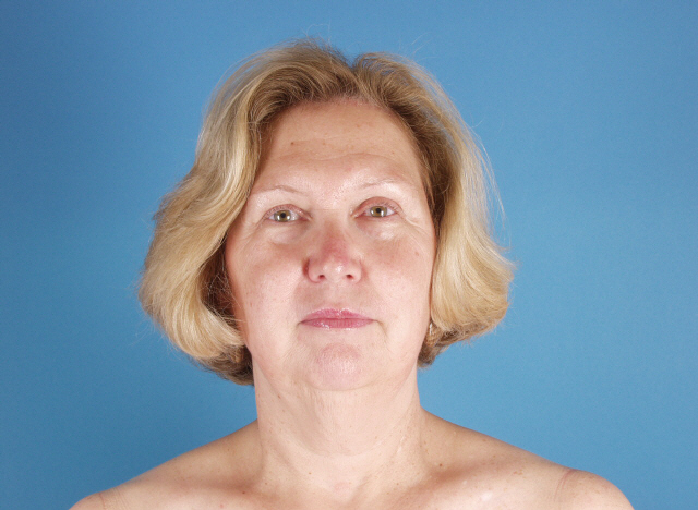 endoscopic brow lift before and after photos