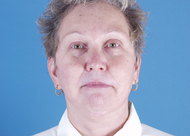 endoscopic brow lift before and after photos