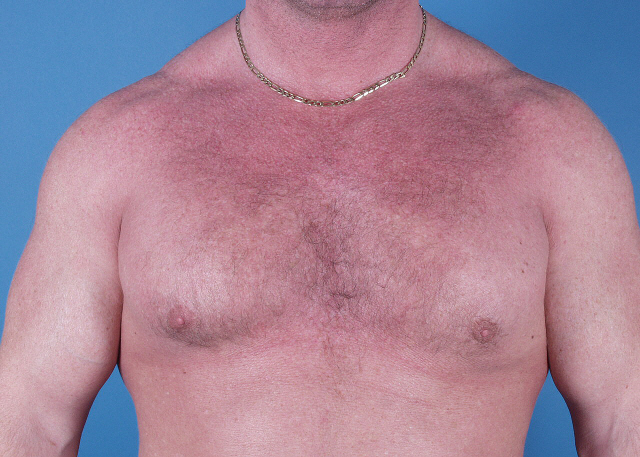 Gynecomastia before and after pictures