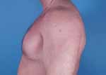 Gynecomastia before and after pictures