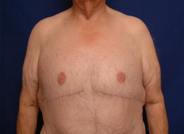 male breast reduction before and after pictures