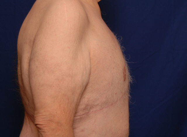 male breast reduction before and after pictures