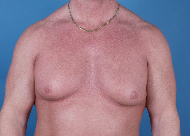Gynecomastia before and after pictures