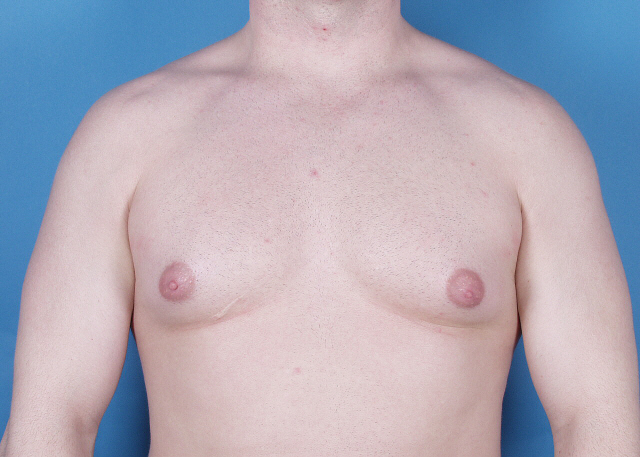 Gynecomastia before and after pictures