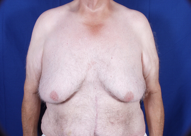 Gynecomastia before and after pictures