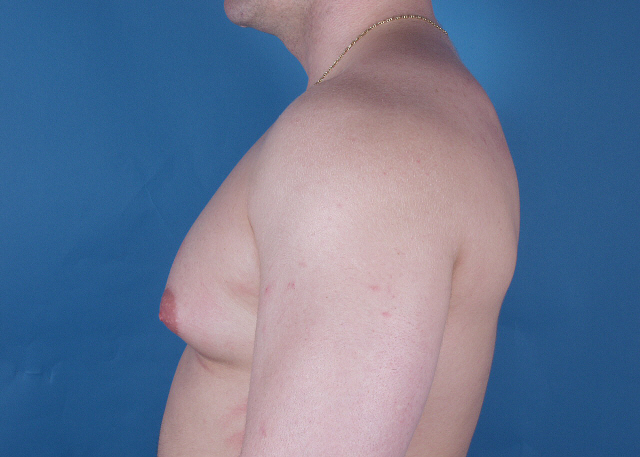 Gynecomastia before and after pictures