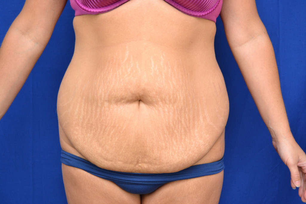 abdominoplasty before after