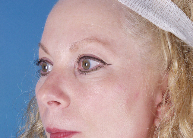 blepharoplasty before and after photos