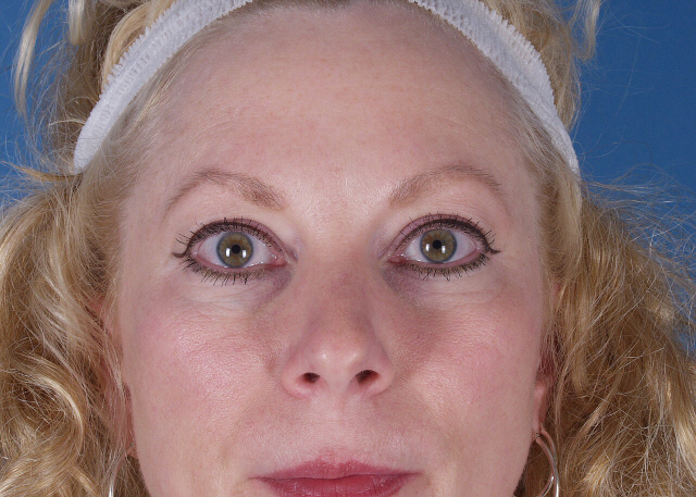blepharoplasty before and after pictures