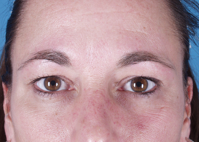 brow lift before and after photos