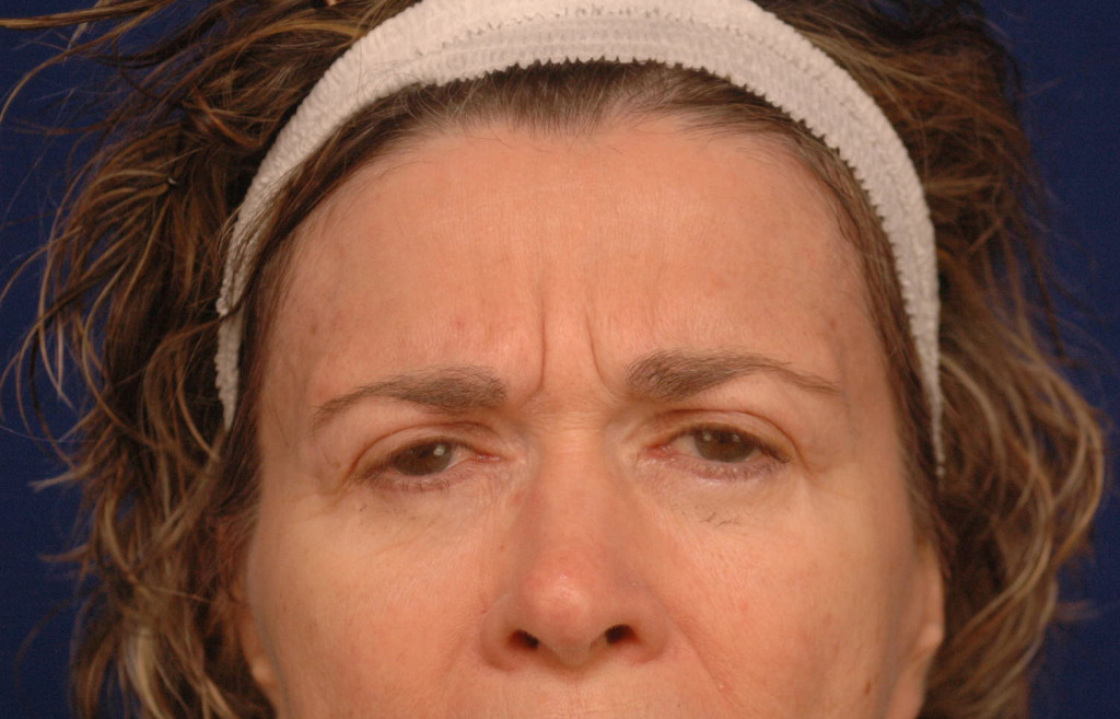 brow lift before and after pictures