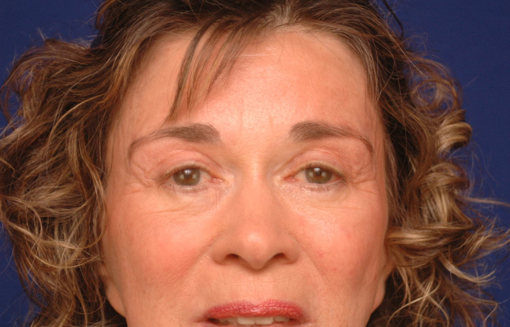 brow lift before and after pictures
