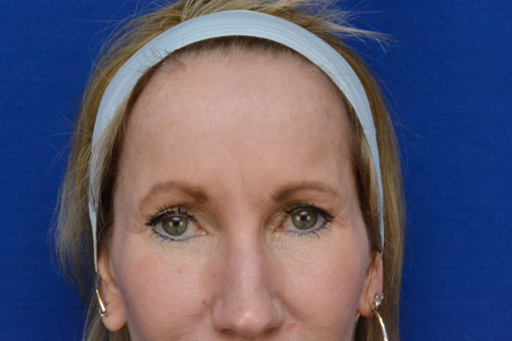 forehead lift before and after