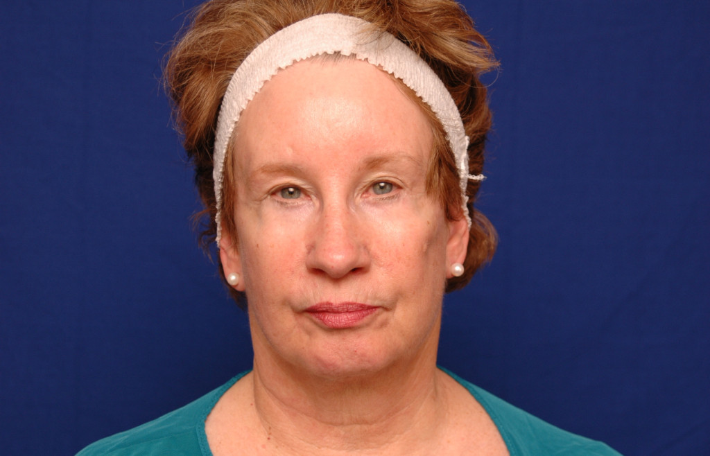 brow lift before and after photos